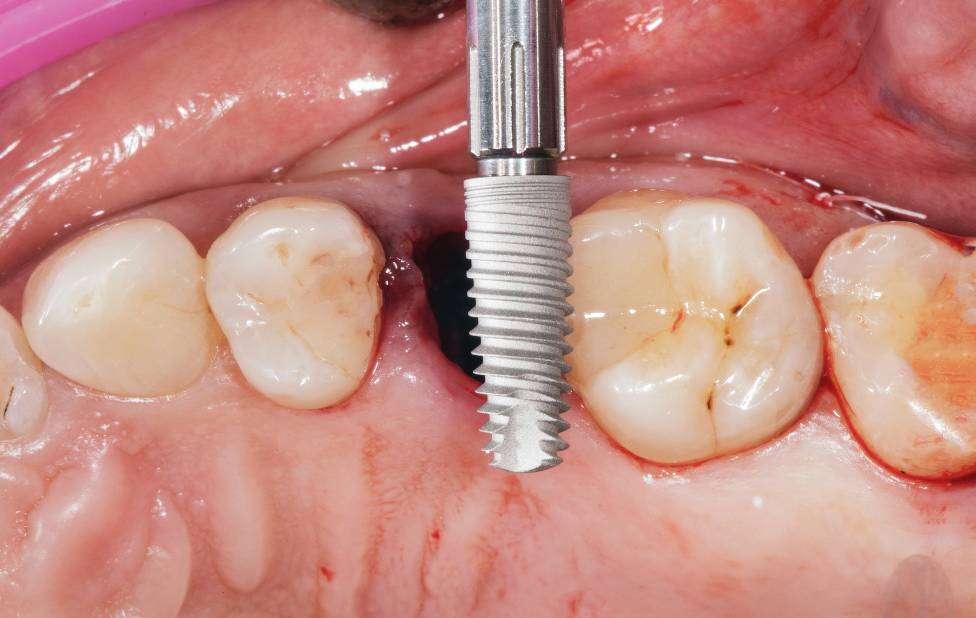 Dental implants: For what age?