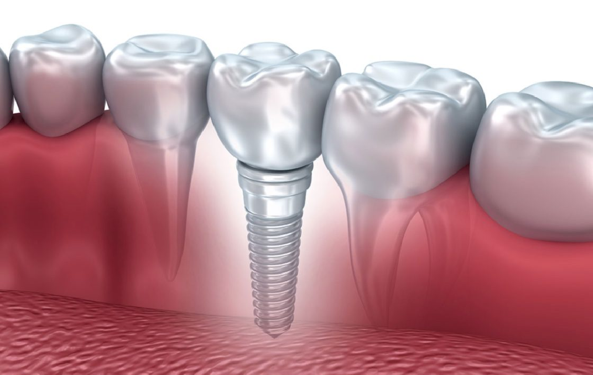 Deadline and price for a dental implant in Casablanca ?