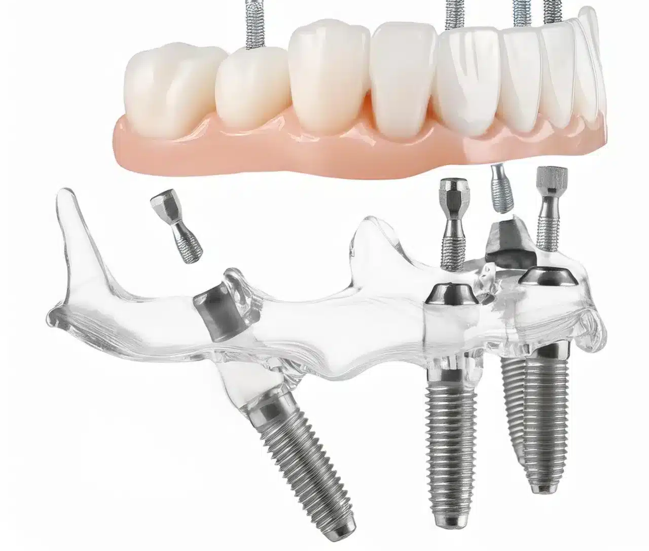 All-on-4 and All-on-6 in Casablanca: get all your teeth back in 24 hours