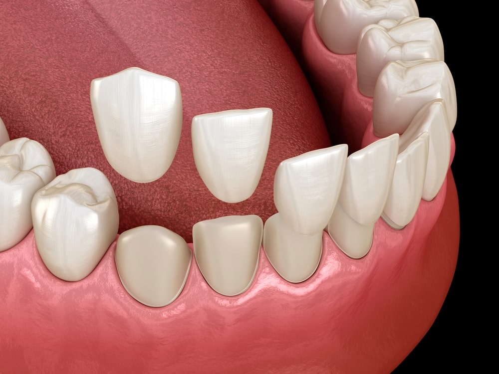 Dental veneers and bruxism: what you need to know before starting