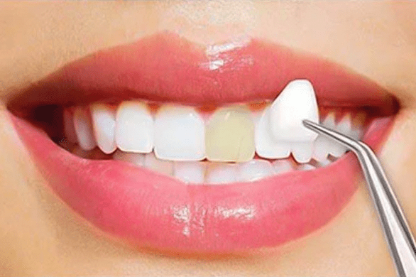 Ceramic vs. composite veneers: which to choose in Casablanca?