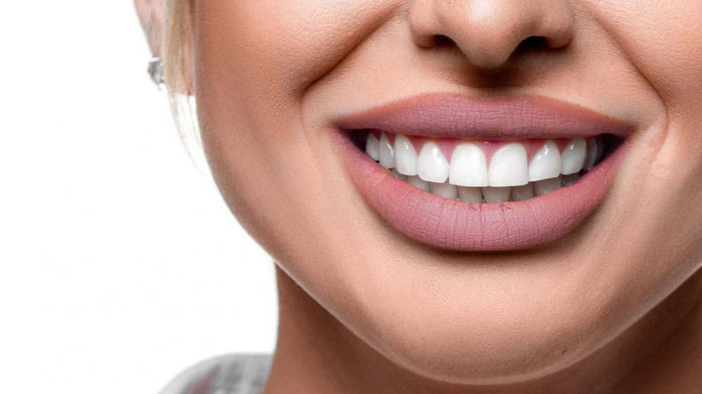 Dental veneers for a Hollywood Smile in Casablanca - Longchamp Clinic