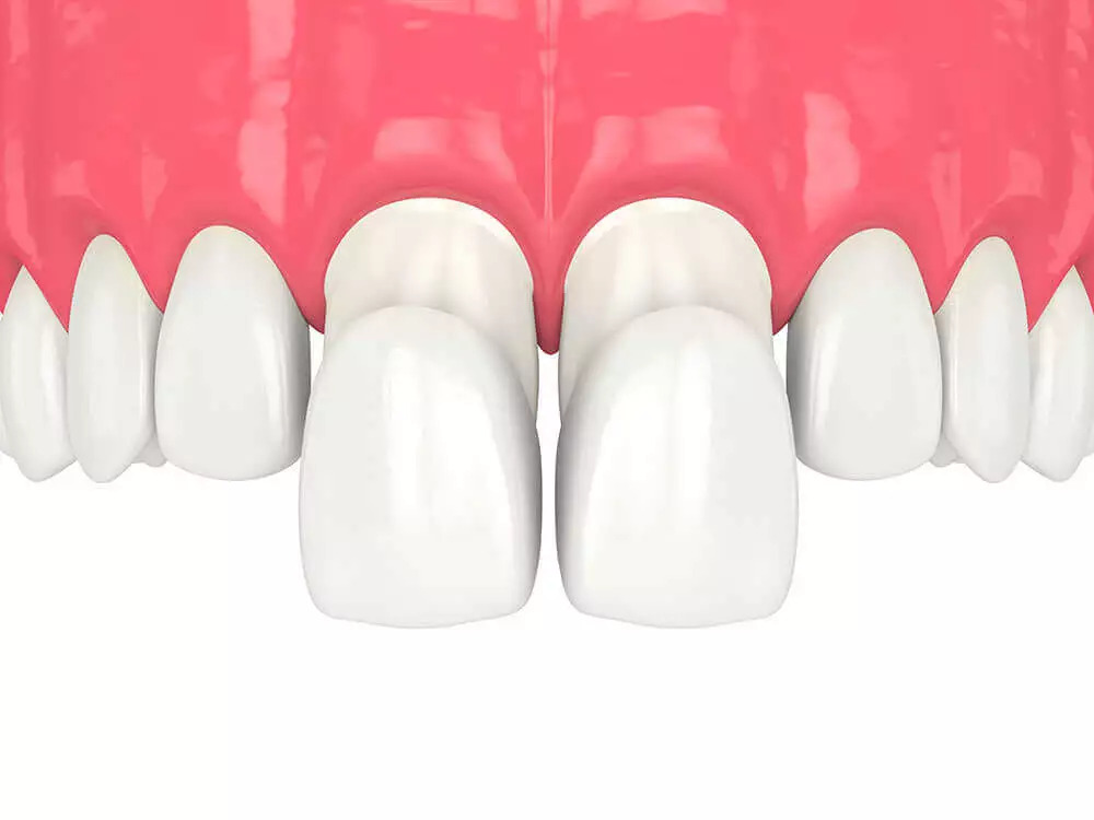 Facettes dentaires sans meulage à Casablanca : est-ce possible ?