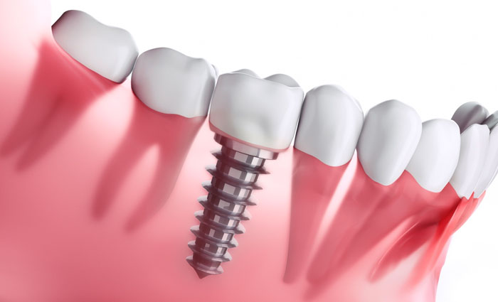 Everything you need to know about dental implants