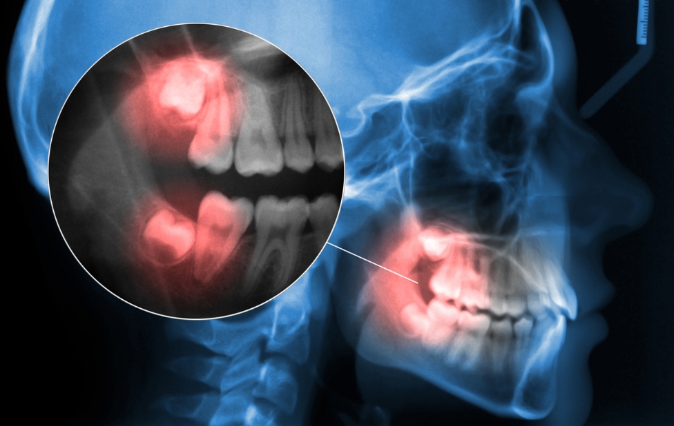 Les implants dentaires pour les dents de sagesse manquantes : Est-ce possible ?