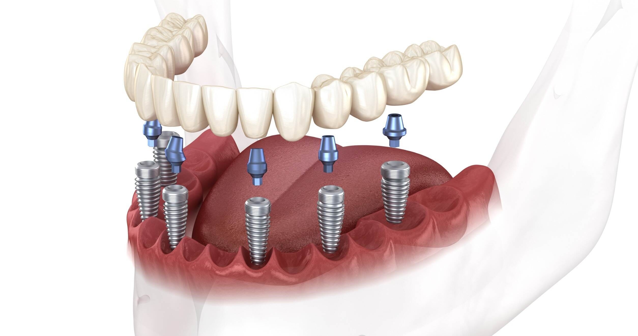 Dental implants in Casablanca: everything you need to know about placement and prices