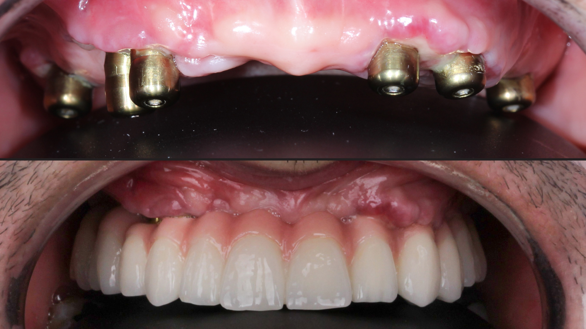 Est-ce que l’implant dentaire fait mal ? Tout savoir avant de se lancer