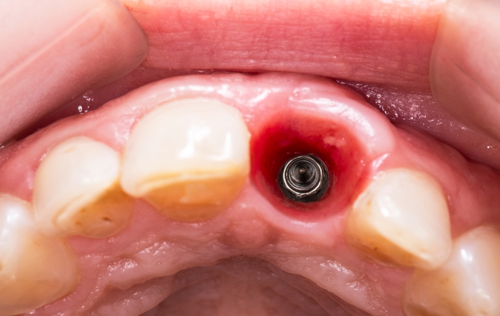 Dental Implants for Patients Who Have Undergone Radiotherapy