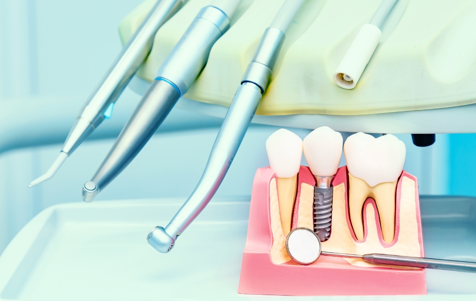 Bio-based dental implants, an ecological revolution in dental implantology?