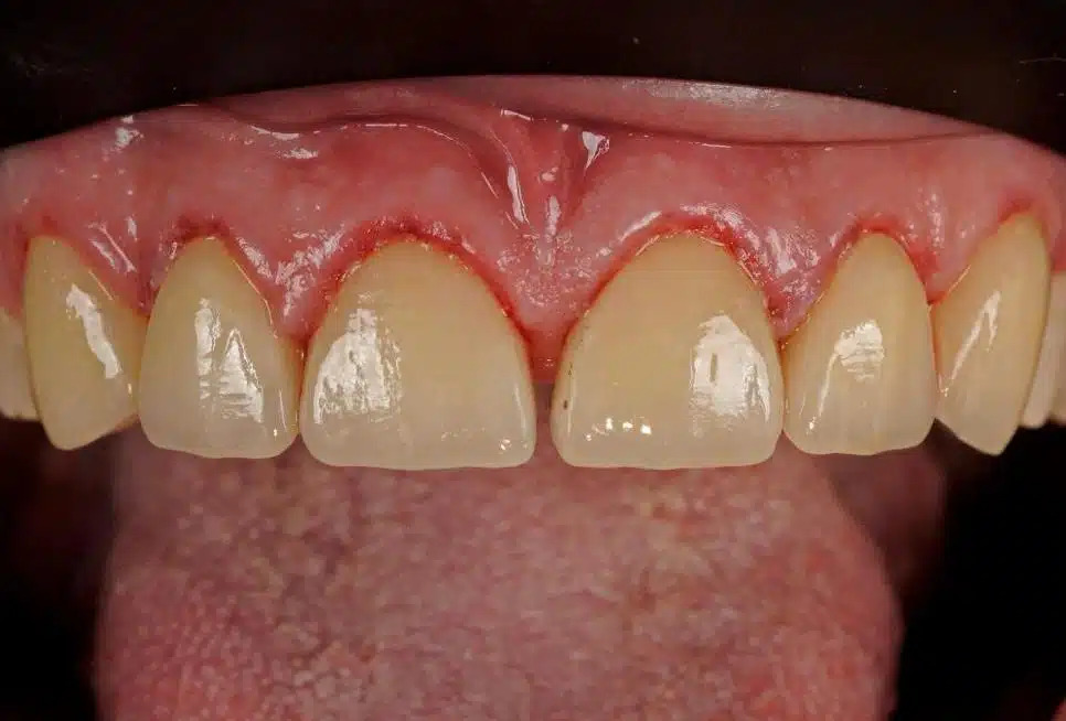 Tooth decay: causes, symptoms and treatments in Casablanca