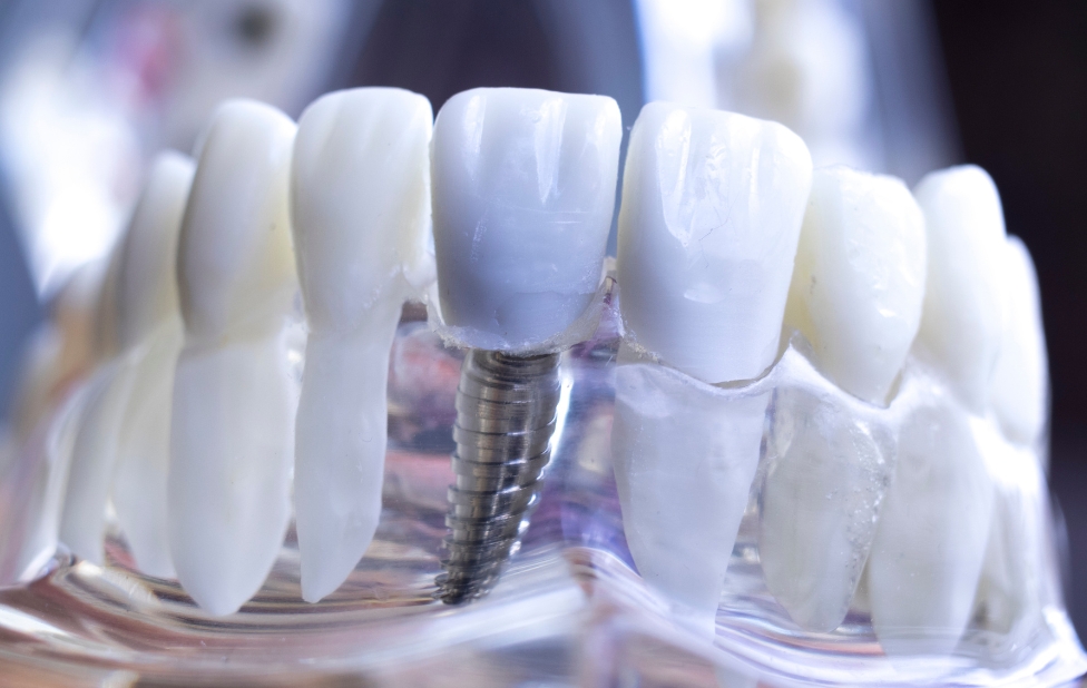 Le processus de maintenance professionnelle des implants dentaires