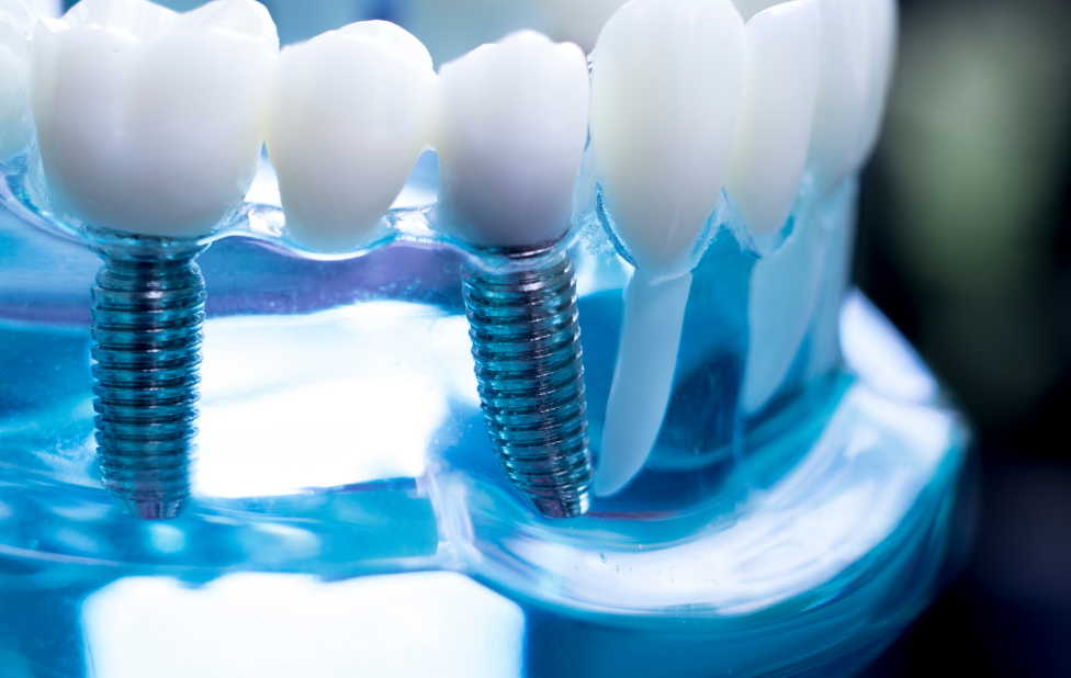 Criteria to consider when choosing a dental implant