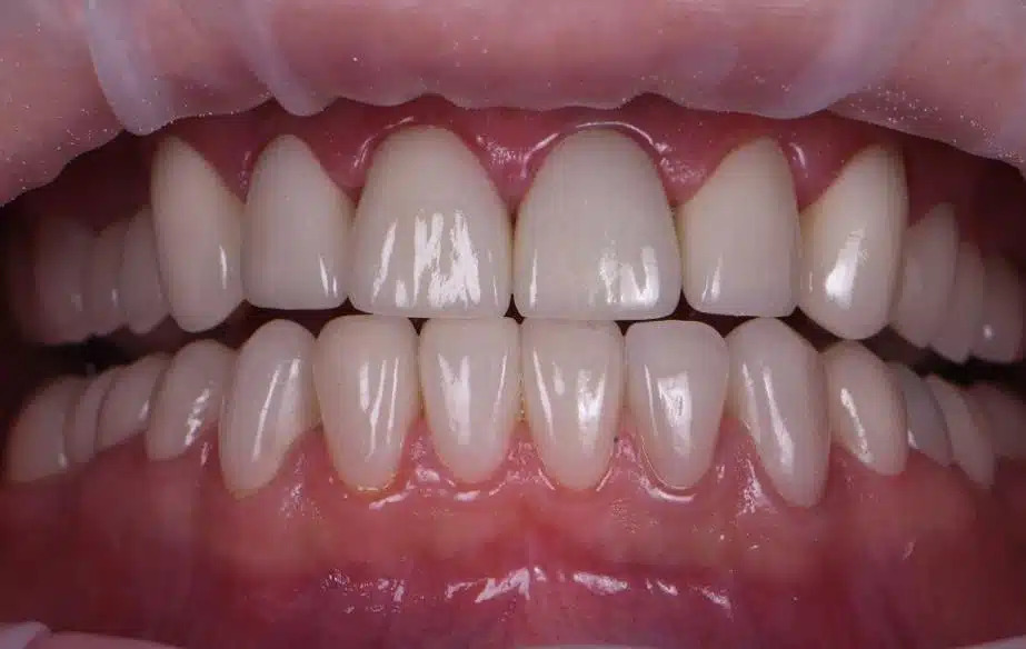 Est-ce que l’implant dentaire fait mal ? Tout savoir avant de se lancer