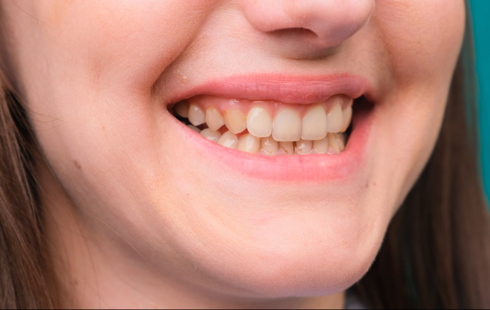 Les causes du jaunissement des dents