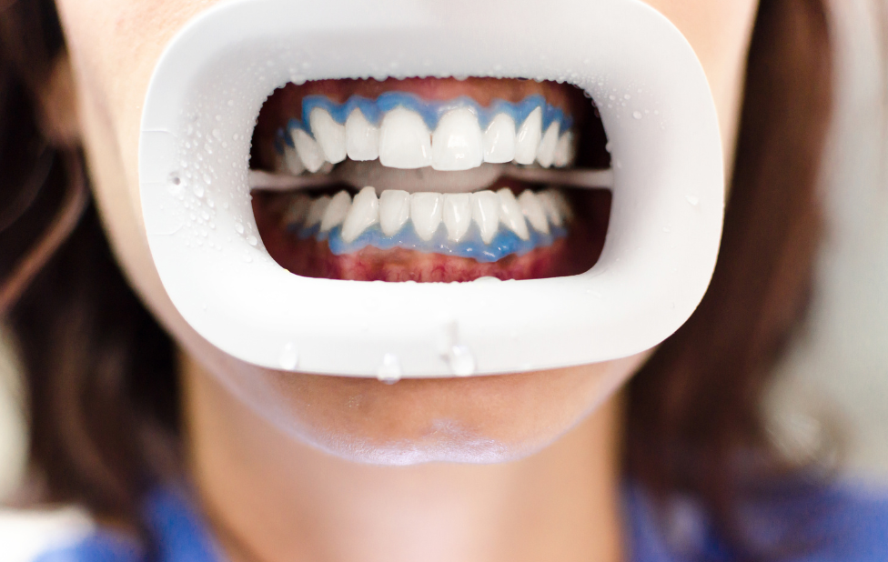 From Coffee to Sparkling Smile, how to Remove Stains with Teeth Whitening?