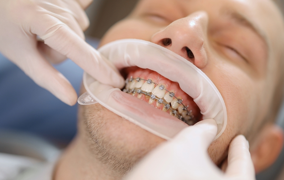 Facettes dentaires vs orthodontie : quelle est la meilleure option ?