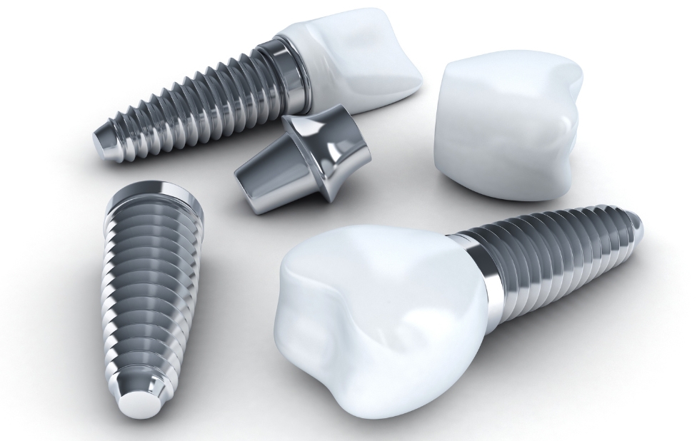 Miniature Dental Implants: An Advanced Solution for Confined Areas