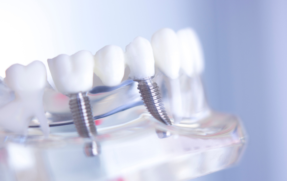 The importance of the jaw bone in the success of dental implants in Casablanca