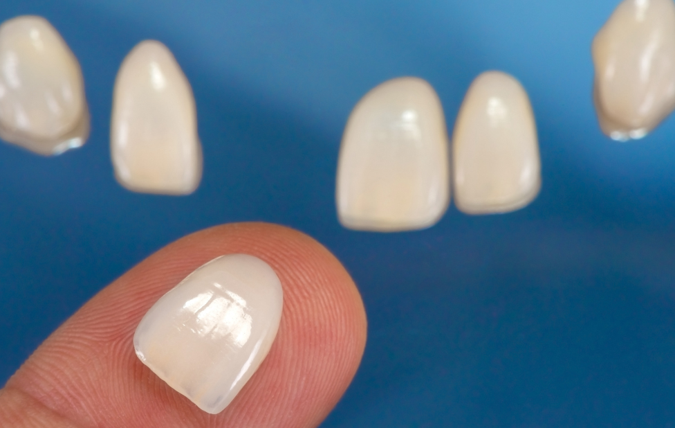 What is a dental veneer and how does it work?