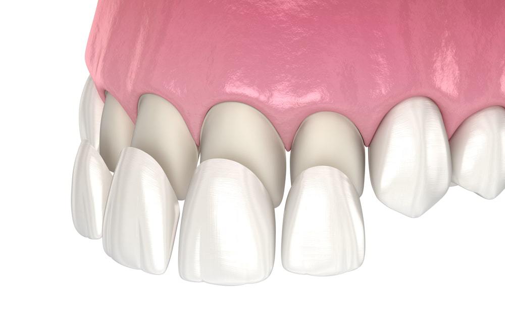 Facettes dentaires à Casablanca : le secret d’un sourire parfait et naturel