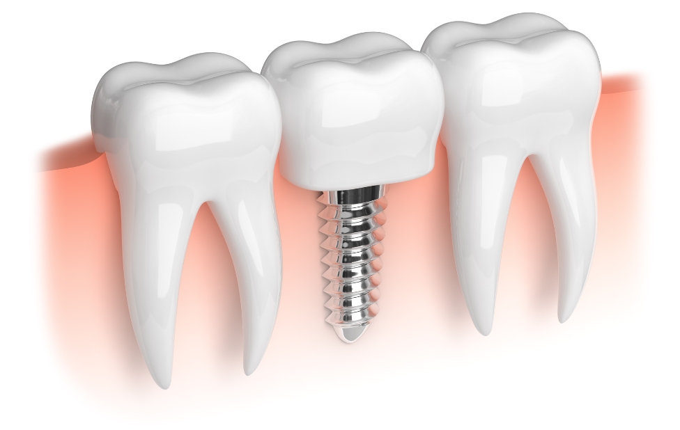 Blanchiment dentaire pour les patients avec des implants dentaires