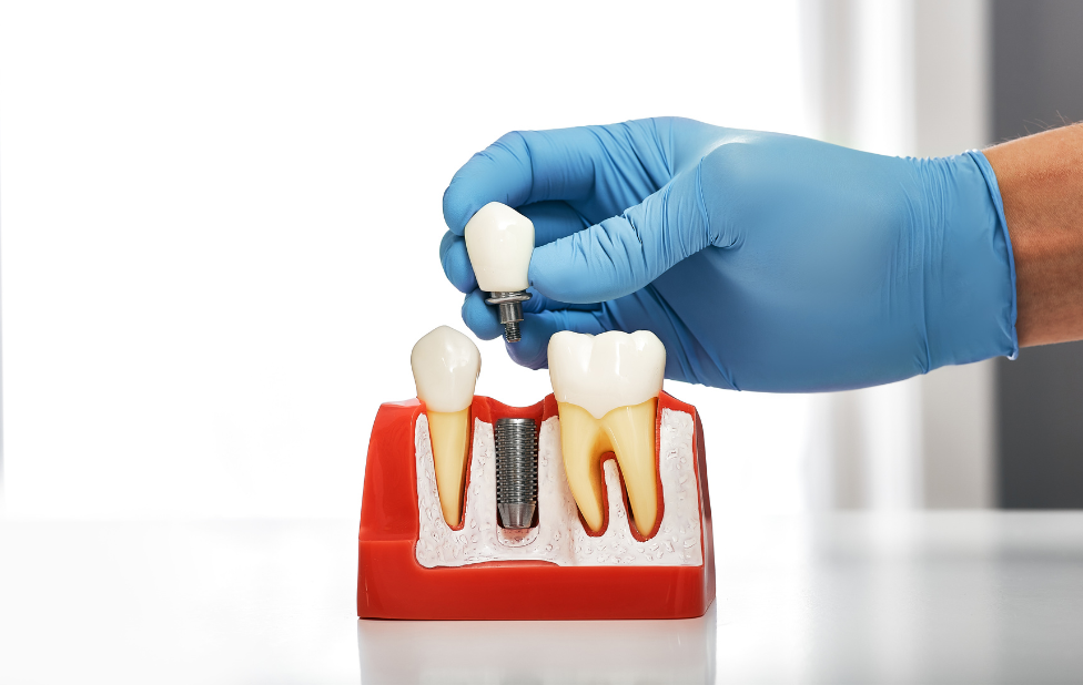 Investing in the Future: The Long-Term Benefits of Dental Implants 