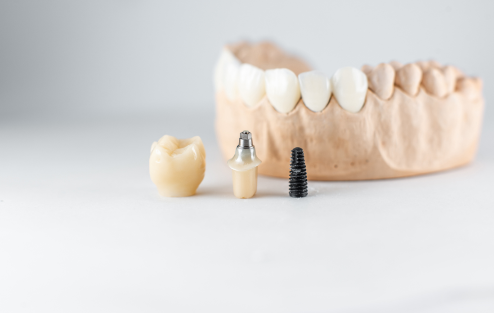 Total Jaw Rehabilitation with Dental Implants