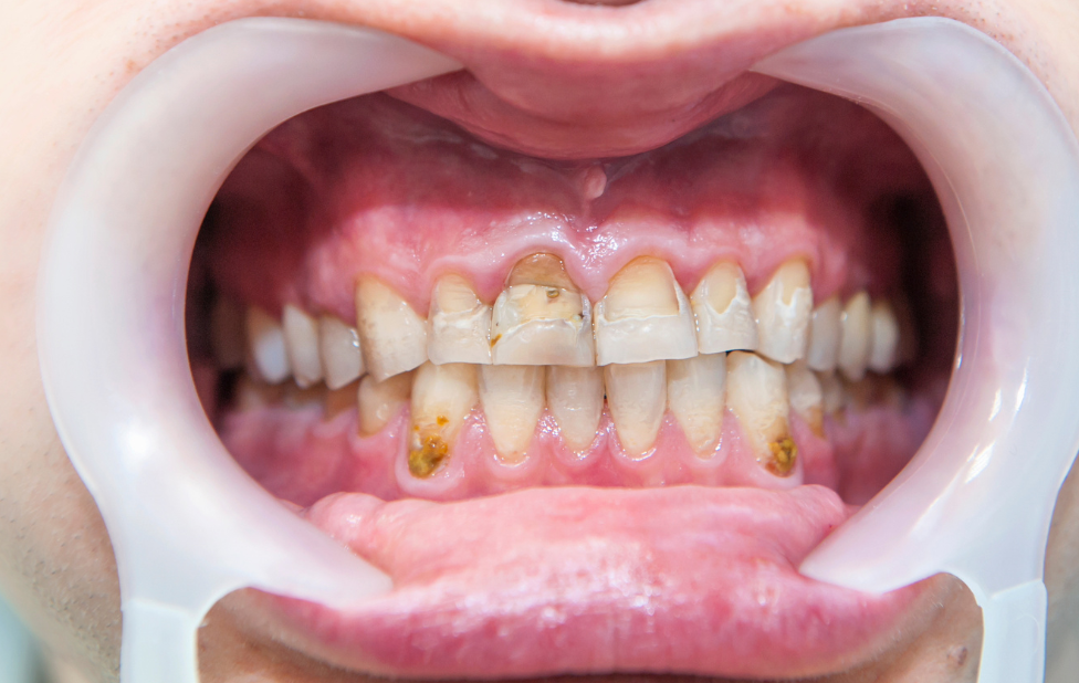 Le blanchiment dentaire pour les dents tachées par le fluor à casablanca