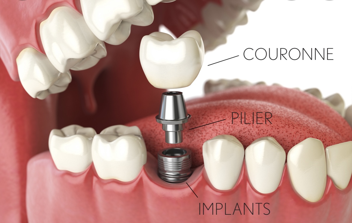 How to choose the best dental implant clinic in Casablanca?