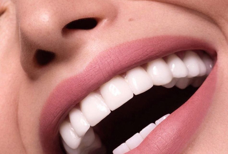 Everything you need to know about dental veneers cost