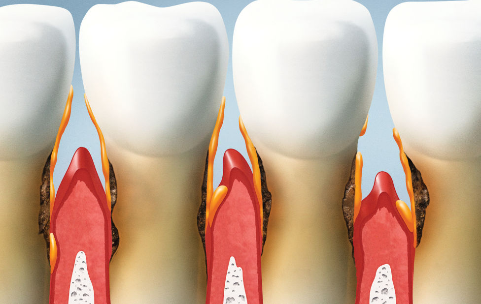 Dental implants for people with gum disease in Casablanca