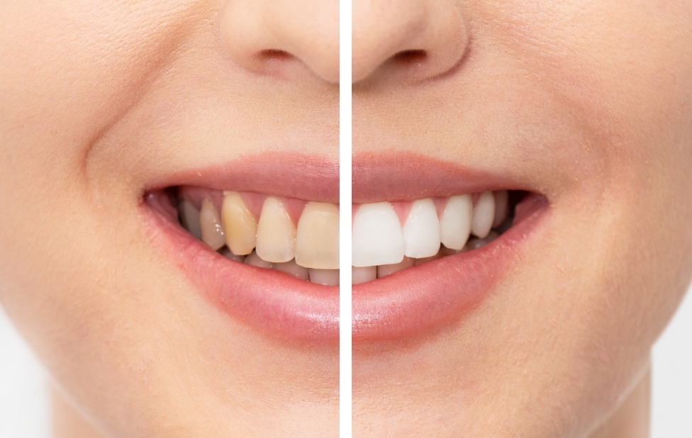 Safe Teeth Whitening: Debunking the Myths and Presenting the Facts