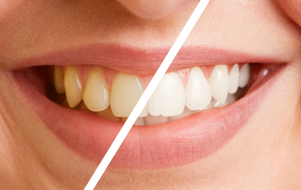 Teeth Whitening Tips and Precautions for Smokers