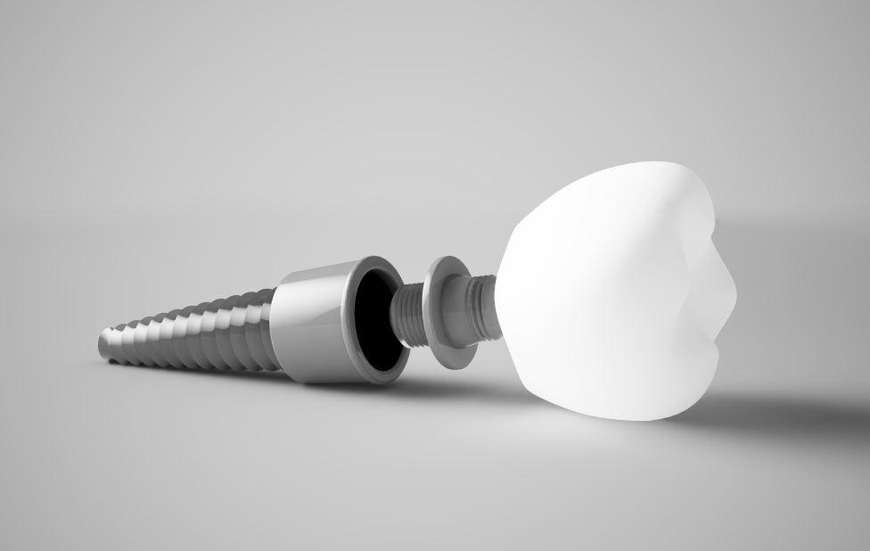 Future Innovations in Dental Implants: What Research Holds for Us