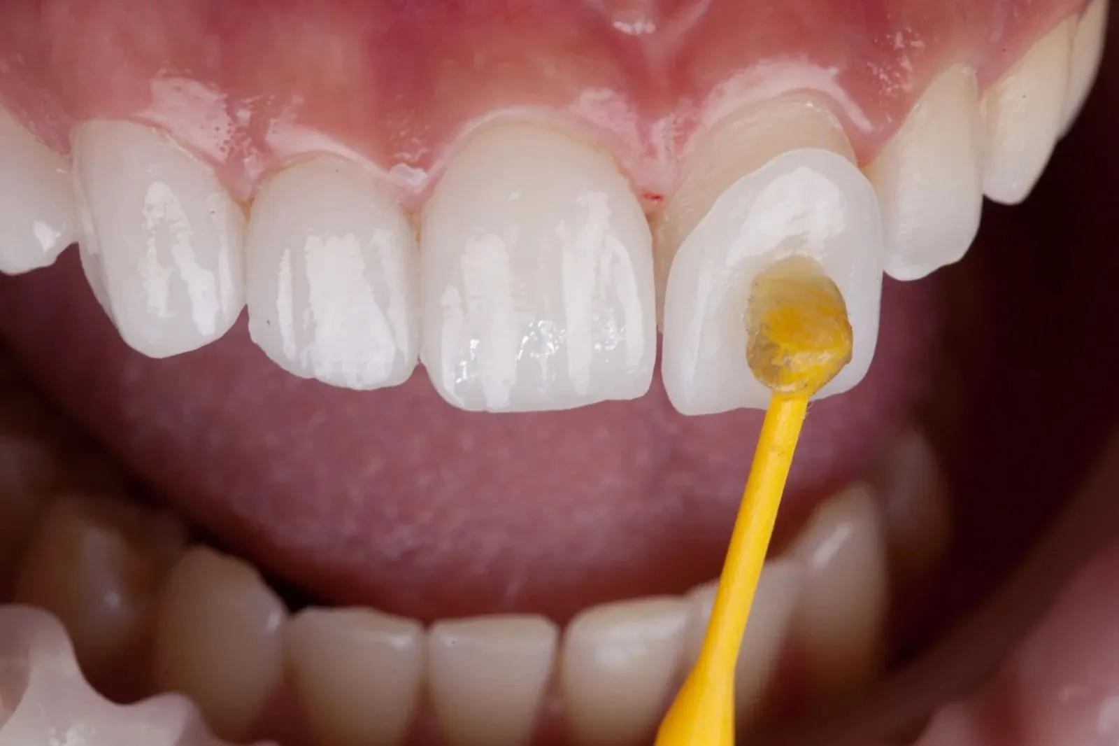 Dental Veneers in Casablanca: Cost, Benefits and Results - Longchamp Dental Clinic