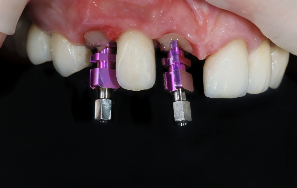 Les implants dentaires pour les patients atteints de mucosite orale