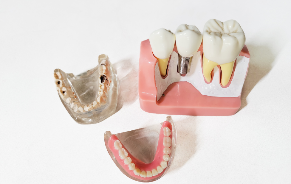 Psychological Factors in the Choice of Dental Implants Understanding Patient Expectations