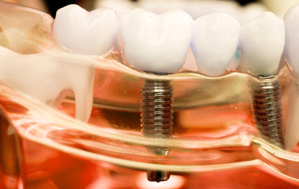 Comment les implants dentaires redonnent un sourire naturel