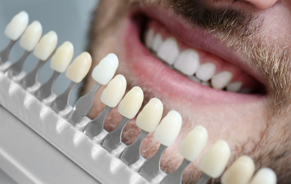 Why Choose Dental Veneers the Popular Choice of Celebrities